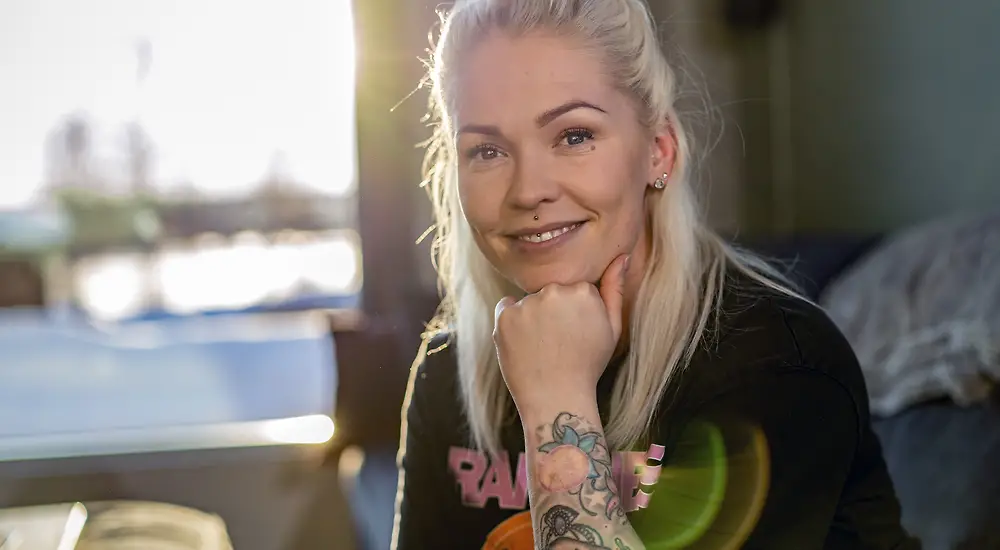 Akuutti: Melanooma - salakavala vieras ihollani